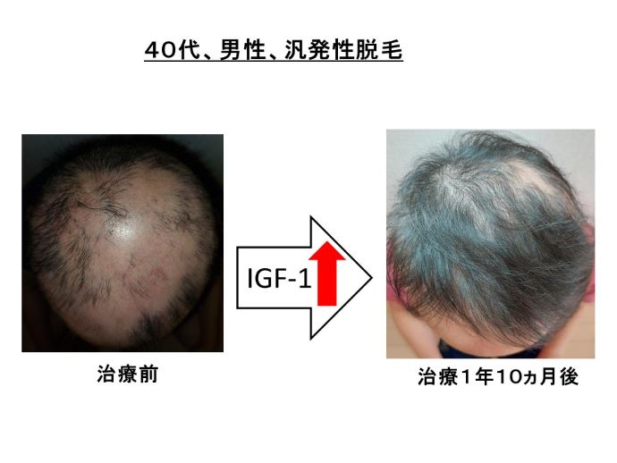 円形脱毛症　病院